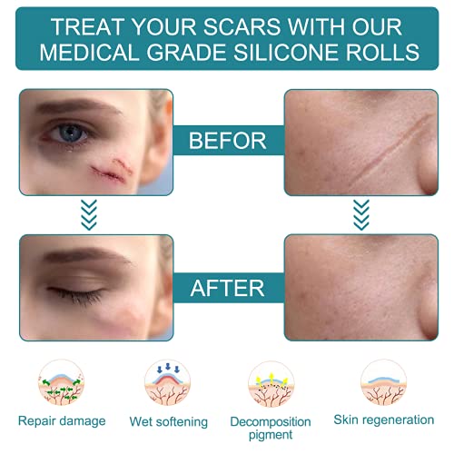 Medical Grade Silicone Scar Sheets