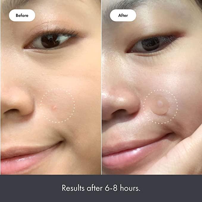 Mighty Patch for Acne and Pimples